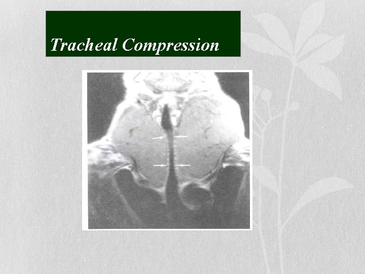 Tracheal Compression 