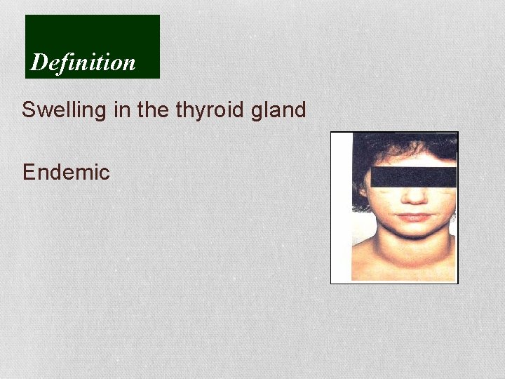 Definition Swelling in the thyroid gland Endemic 