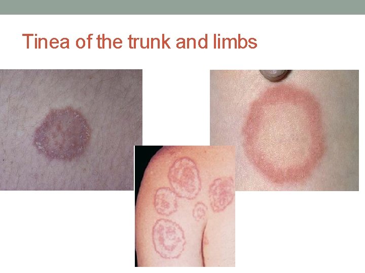 Tinea of the trunk and limbs 