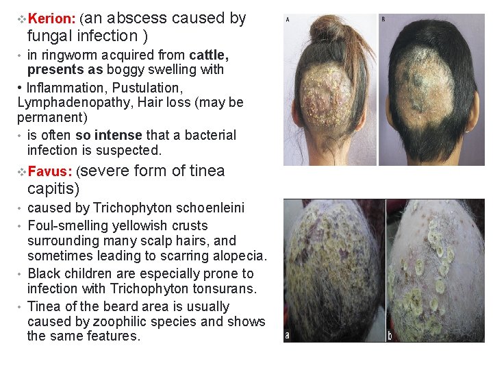 v. Kerion: (an abscess caused by fungal infection ) • in ringworm acquired from