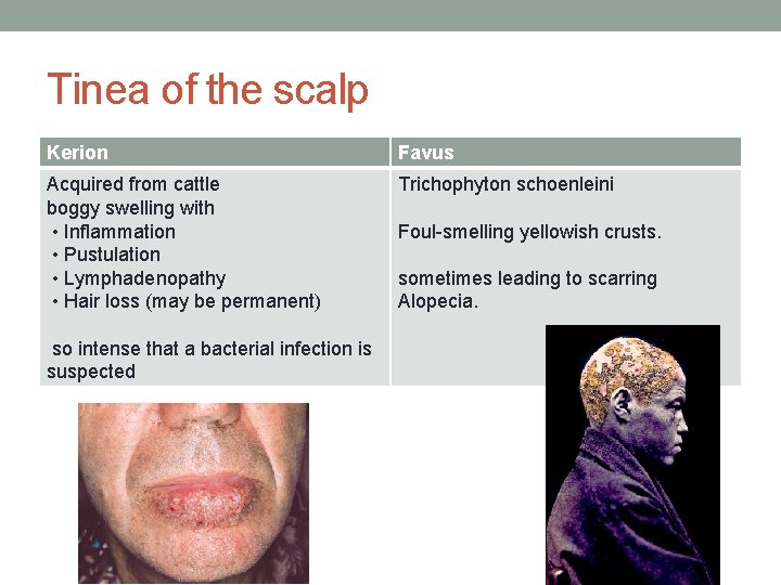 Tinea of the scalp Kerion Favus Acquired from cattle boggy swelling with • Inflammation