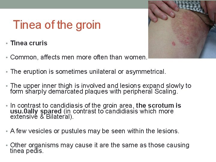 Tinea of the groin • Tinea cruris • Common, affects men more often than