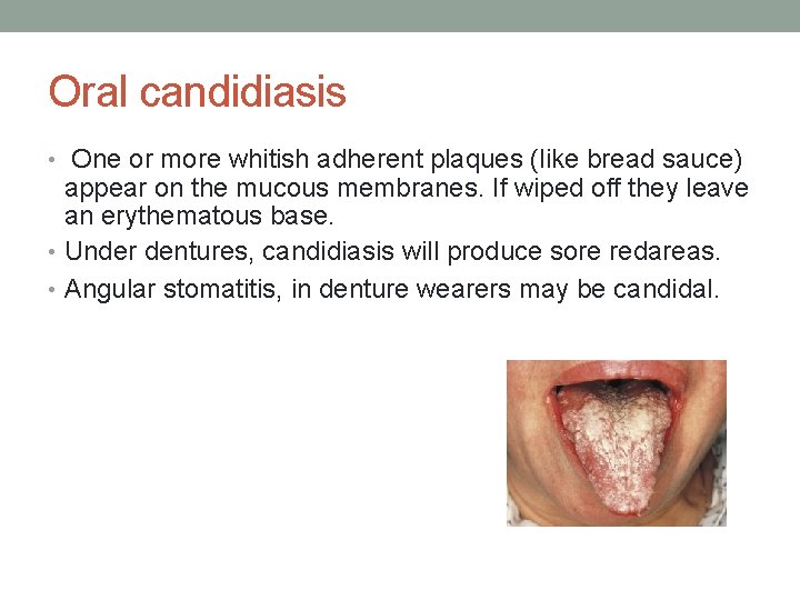 Oral candidiasis • One or more whitish adherent plaques (like bread sauce) appear on