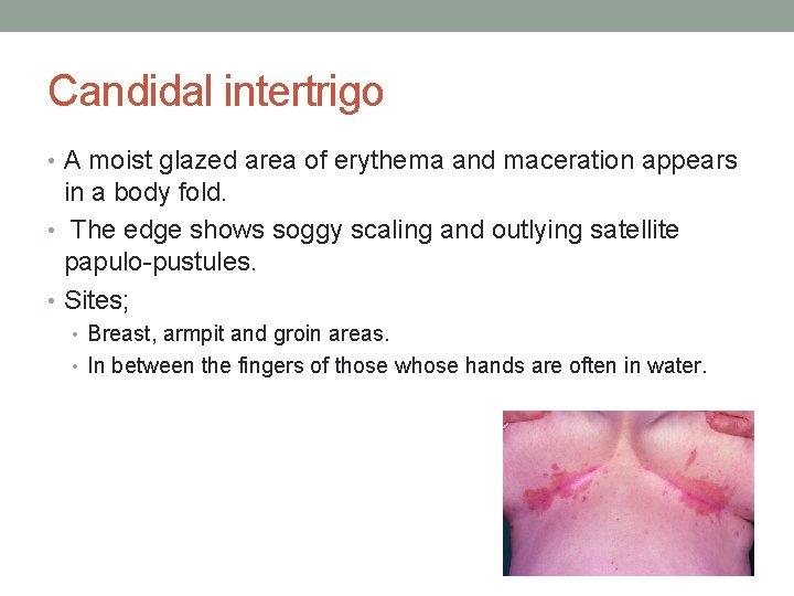 Candidal intertrigo • A moist glazed area of erythema and maceration appears in a