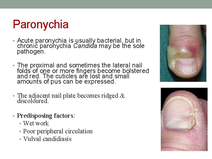 Paronychia • Acute paronychia is usually bacterial, but in chronic paronychia Candida may be