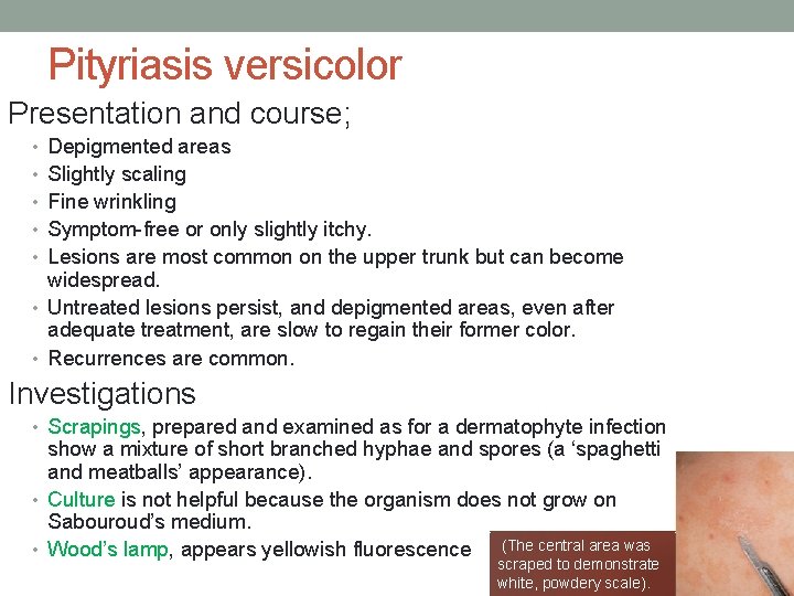 Pityriasis versicolor Presentation and course; • Depigmented areas • Slightly scaling • Fine wrinkling