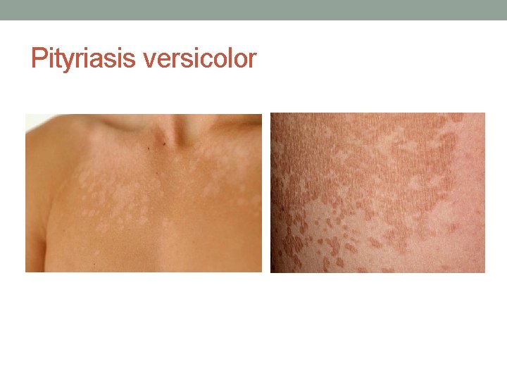 Pityriasis versicolor 