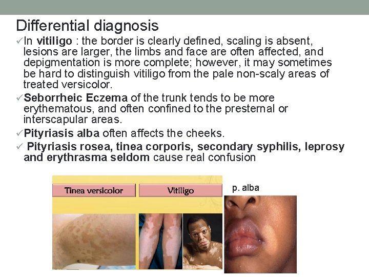 Differential diagnosis üIn vitiligo : the border is clearly defined, scaling is absent, lesions