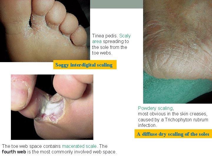 Tinea pedis. Scaly area spreading to the sole from the toe webs. Soggy interdigital