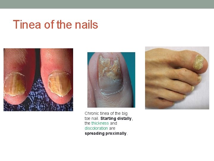 Tinea of the nails Chronic tinea of the big toe nail. Starting distally, the