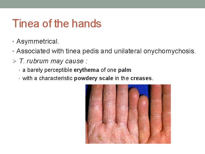 Tinea of the hands • Asymmetrical. • Associated with tinea pedis and unilateral onychomychosis.