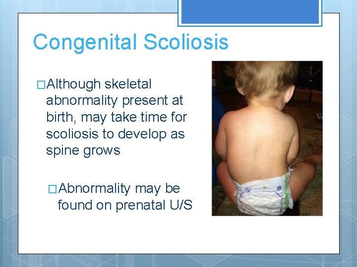 Congenital Scoliosis �Although skeletal abnormality present at birth, may take time for scoliosis to