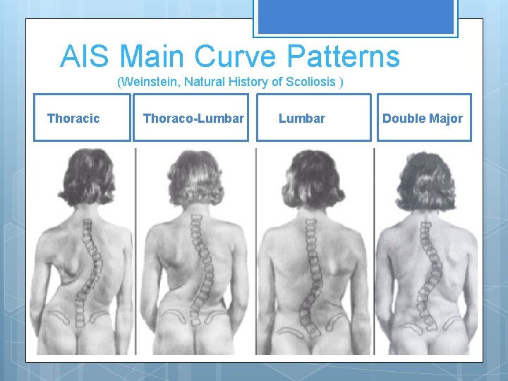 AIS Main Curve Patterns (Weinstein, Natural History of Scoliosis ) Thoracic Thoraco-Lumbar Double Major