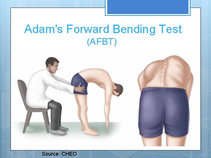 Adam's Forward Bending Test (AFBT) Source: CHEO 