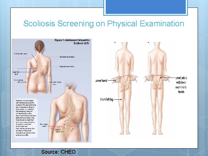 Scoliosis Screening on Physical Examination Source: CHEO 