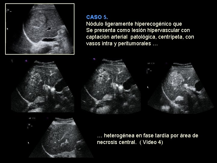 CASO 5. Nódulo ligeramente hiperecogénico que Se presenta como lesión hipervascular con captación arterial