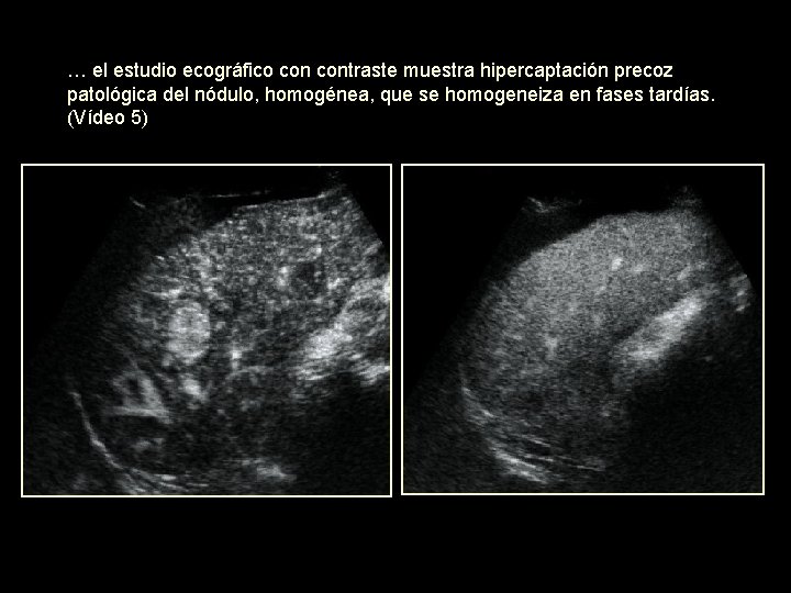 … el estudio ecográfico contraste muestra hipercaptación precoz patológica del nódulo, homogénea, que se