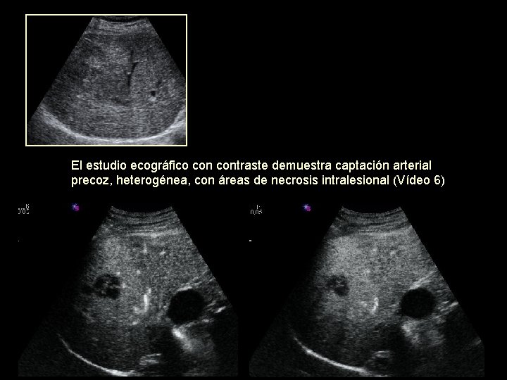 El estudio ecográfico contraste demuestra captación arterial precoz, heterogénea, con áreas de necrosis intralesional