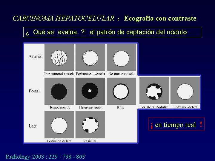 CARCINOMA HEPATOCELULAR : Ecografía contraste ¿ Qué se evalúa ? : el patrón de