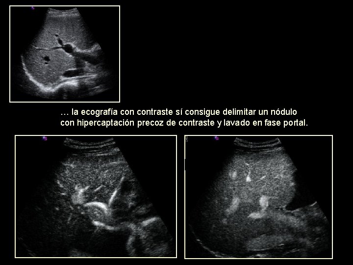 … la ecografía contraste sí consigue delimitar un nódulo con hipercaptación precoz de contraste