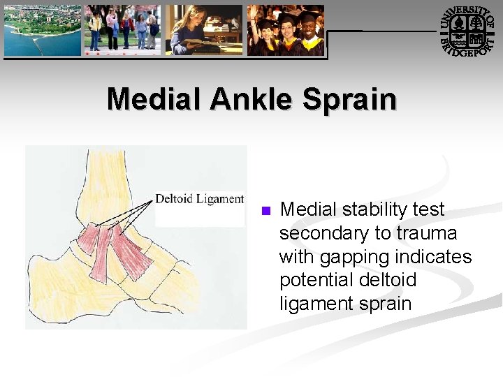 Medial Ankle Sprain n Medial stability test secondary to trauma with gapping indicates potential