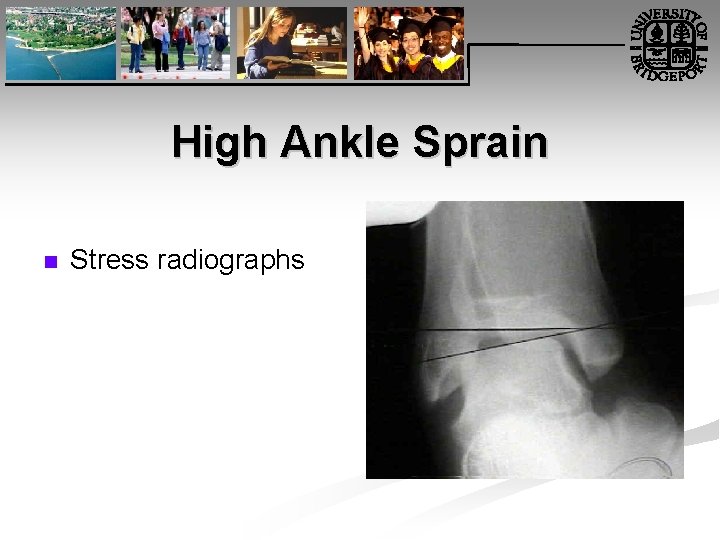 High Ankle Sprain n Stress radiographs 