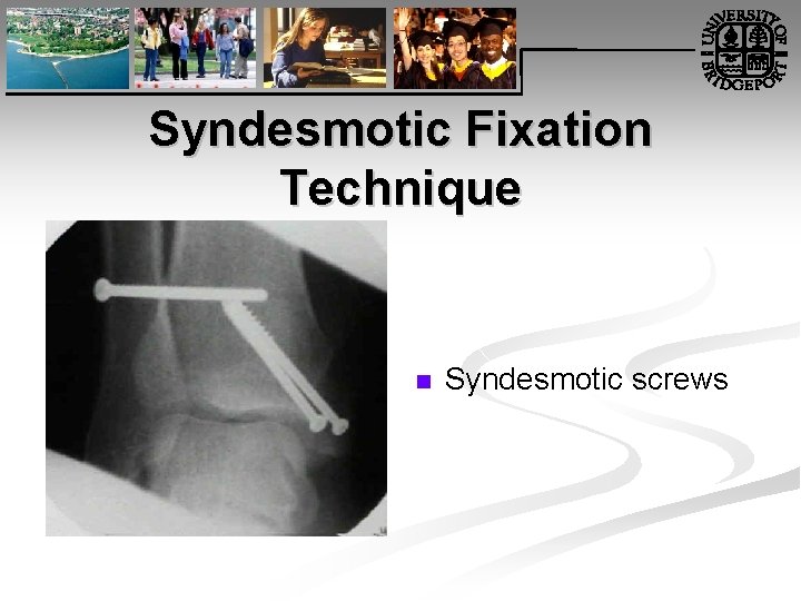 Syndesmotic Fixation Technique n Syndesmotic screws 