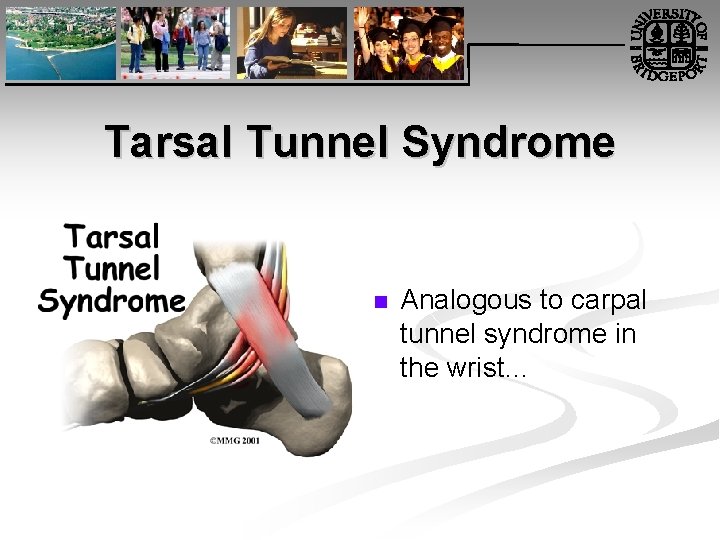 Tarsal Tunnel Syndrome n Analogous to carpal tunnel syndrome in the wrist… 