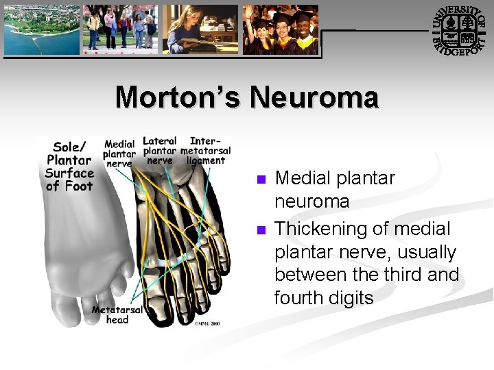 Morton’s Neuroma n n Medial plantar neuroma Thickening of medial plantar nerve, usually between