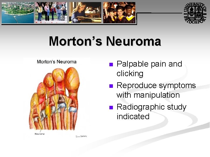 Morton’s Neuroma n n n Palpable pain and clicking Reproduce symptoms with manipulation Radiographic