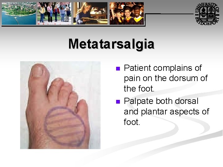 Metatarsalgia n n Patient complains of pain on the dorsum of the foot. Palpate