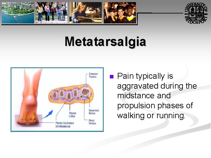 Metatarsalgia n Pain typically is aggravated during the midstance and propulsion phases of walking