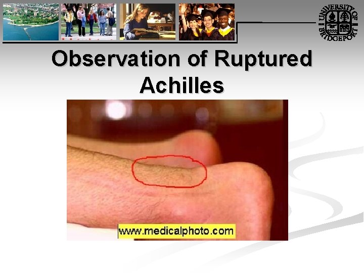 Observation of Ruptured Achilles 