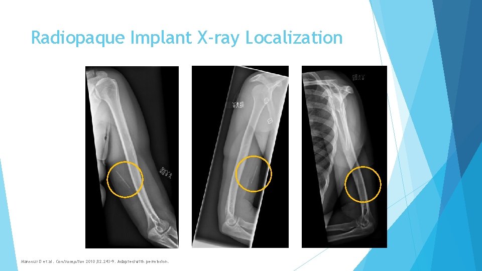 Radiopaque Implant X-ray Localization Mansour D et al. Contraception 2010; 82: 243– 9. Adapted