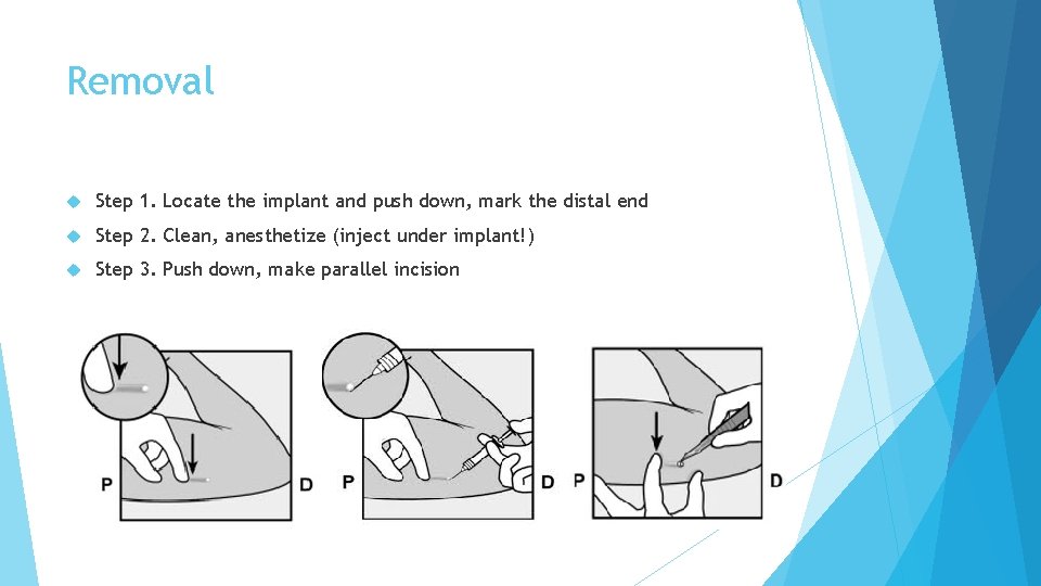 Removal Step 1. Locate the implant and push down, mark the distal end Step