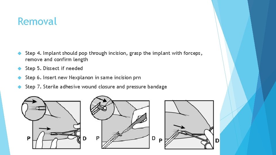 Removal Step 4. Implant should pop through incision, grasp the implant with forceps, remove