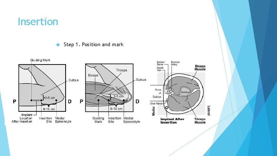 Insertion Step 1. Position and mark 