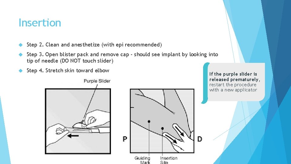 Insertion Step 2. Clean and anesthetize (with epi recommended) Step 3. Open blister pack