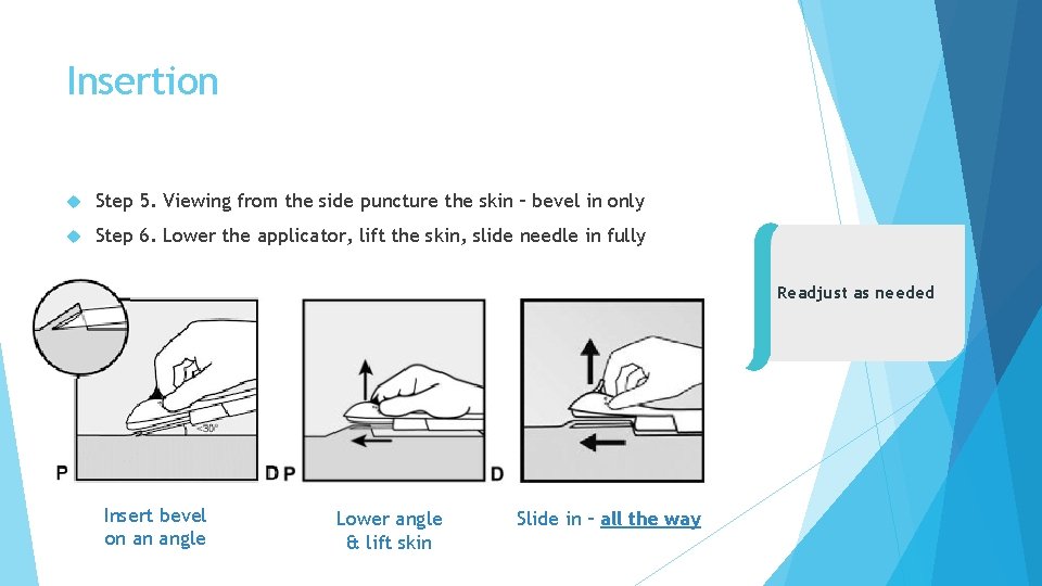 Insertion Step 5. Viewing from the side puncture the skin – bevel in only