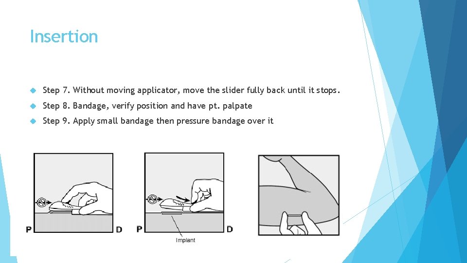 Insertion Step 7. Without moving applicator, move the slider fully back until it stops.