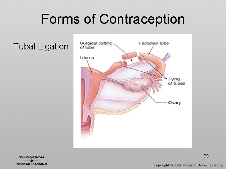 Forms of Contraception Tubal Ligation 29 