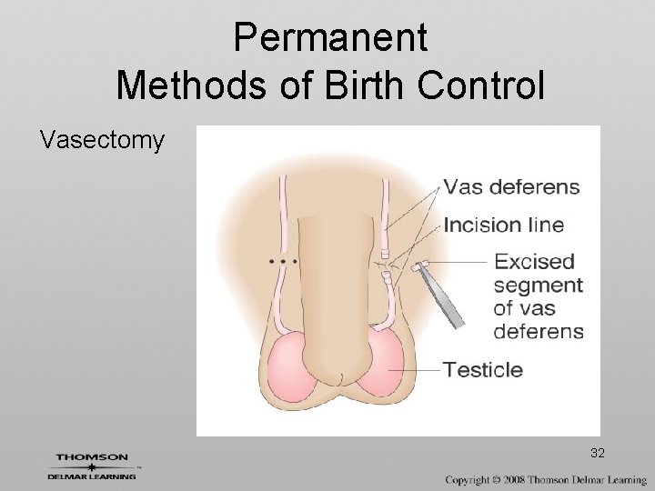 Permanent Methods of Birth Control Vasectomy 32 