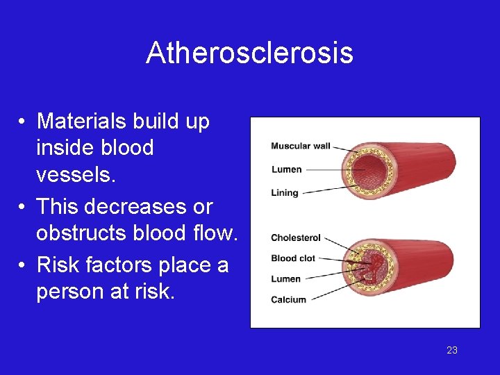 Atherosclerosis • Materials build up inside blood vessels. • This decreases or obstructs blood