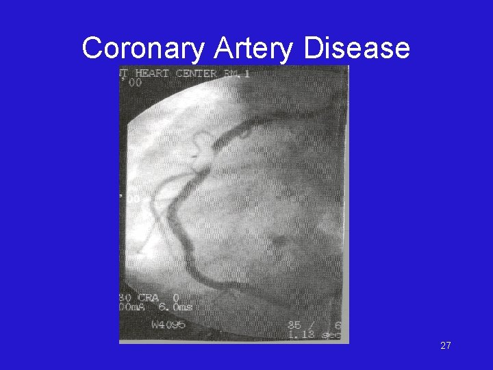 Coronary Artery Disease 27 