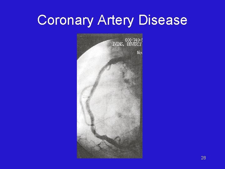 Coronary Artery Disease 28 