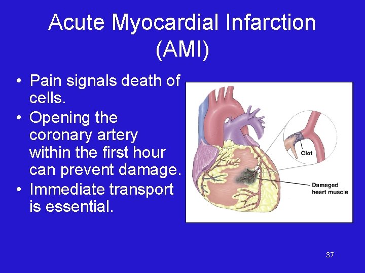 Acute Myocardial Infarction (AMI) • Pain signals death of cells. • Opening the coronary
