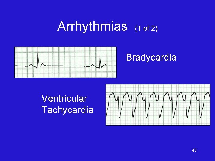 Arrhythmias (1 of 2) Bradycardia Ventricular Tachycardia 43 