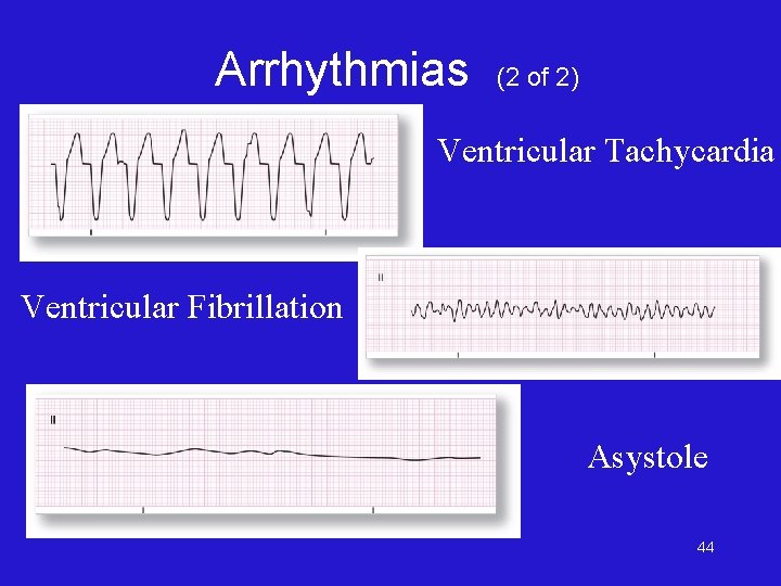 Arrhythmias (2 of 2) Ventricular Tachycardia Ventricular Fibrillation Asystole 44 