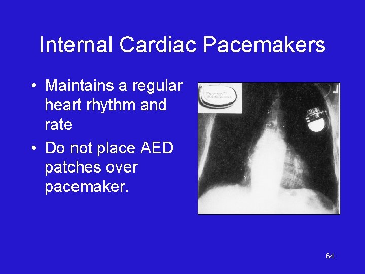 Internal Cardiac Pacemakers • Maintains a regular heart rhythm and rate • Do not