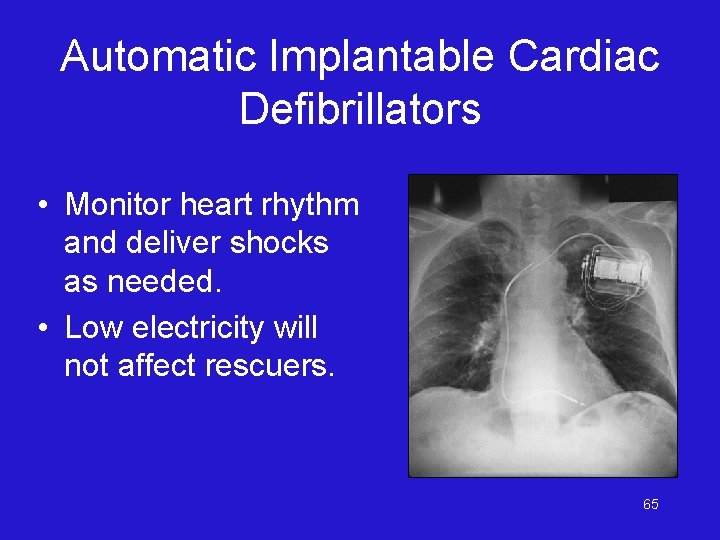 Automatic Implantable Cardiac Defibrillators • Monitor heart rhythm and deliver shocks as needed. •